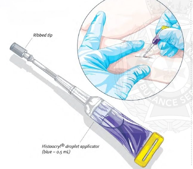 skin closure using NBCA