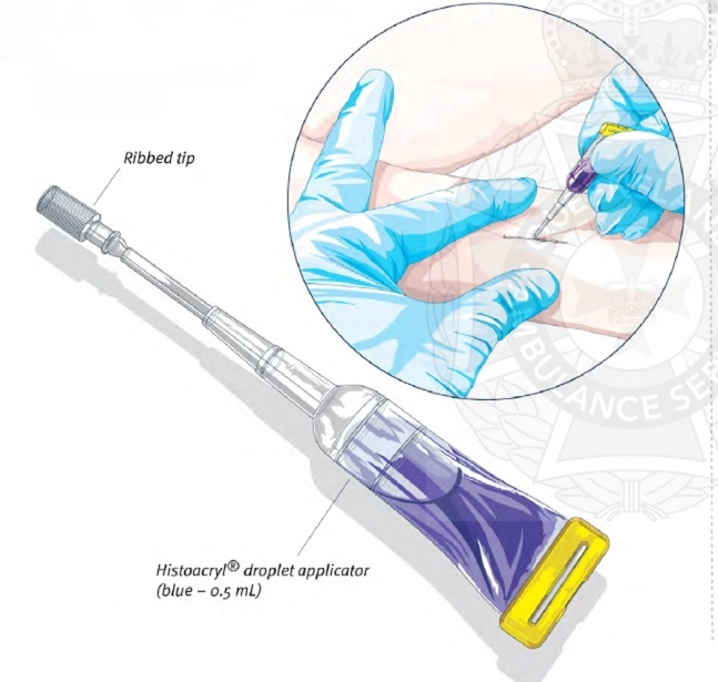skin closure using NBCA