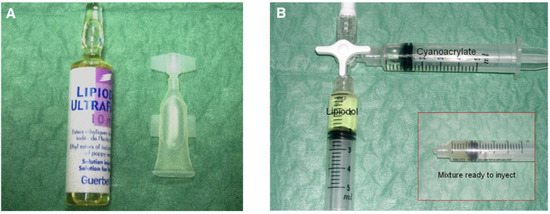 Histoacryl with Lipiodol