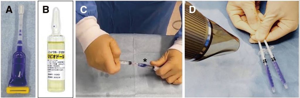 nbca-lipiodol mixture