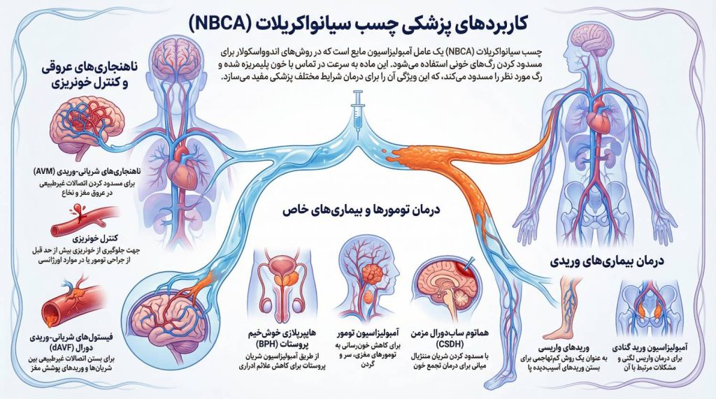NBCA glue medical applications